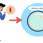 Alternaria alerjisi solunum (İnhalasyon) alerjileri