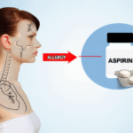 Aspirin alerjisi ilac alerjileri