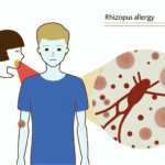 Rhizopus alerjisi solunum (İnhalasyon) alerjileri