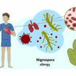 Nigrospora alerjisi solunum (İnhalasyon) alerjileri